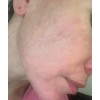 Crema Despigmentante De Paño Melasma Acne