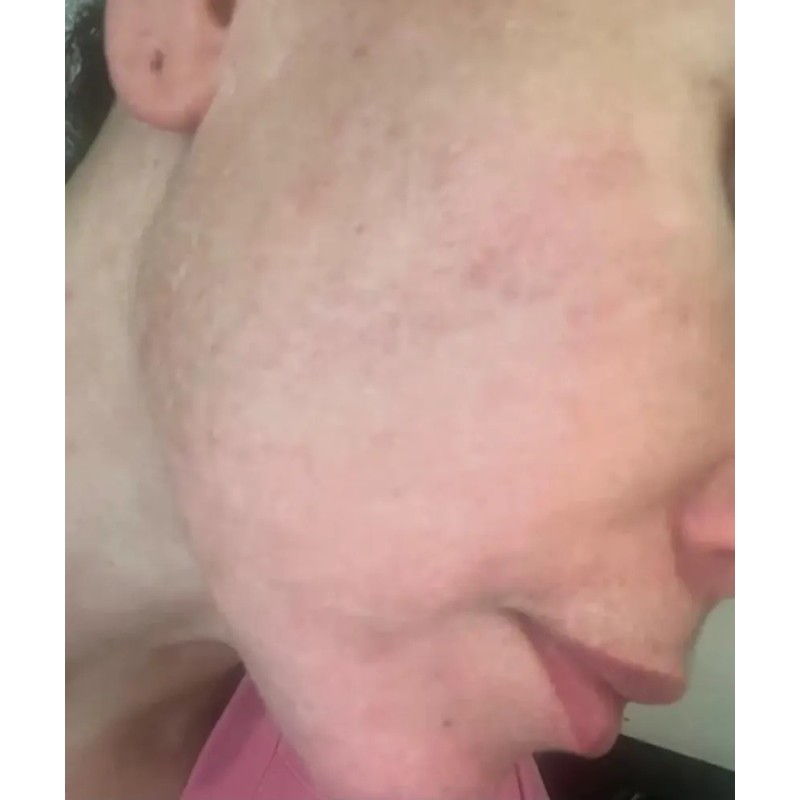 Crema Despigmentante De Paño Melasma Acne