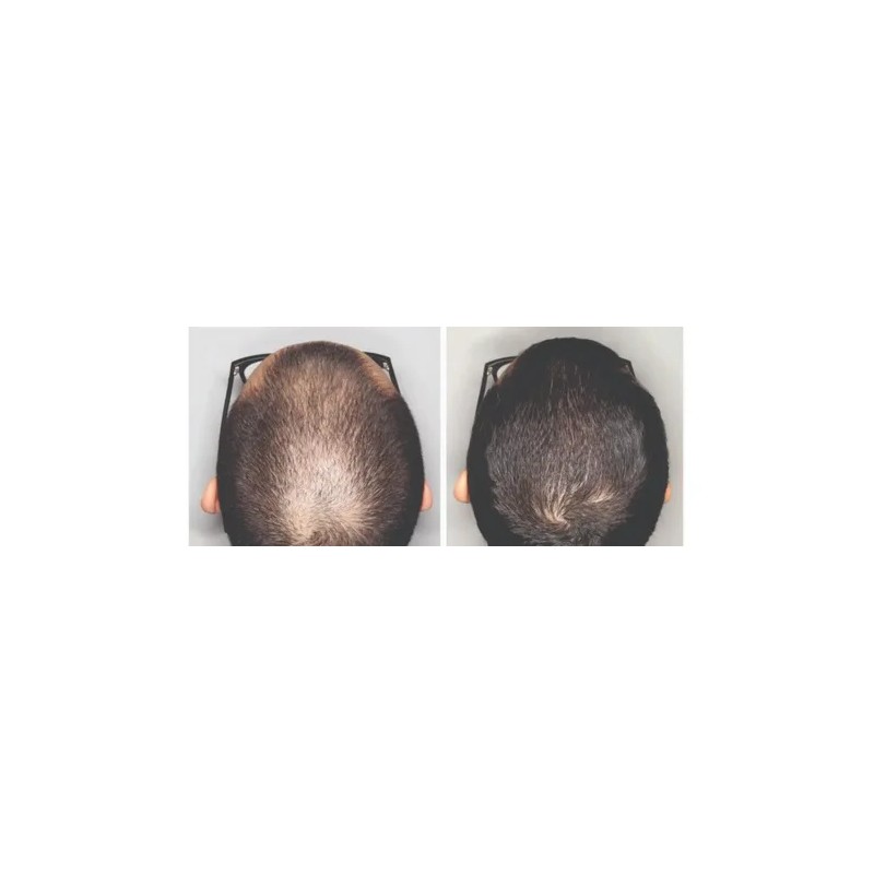 Tratamiento Anticaída De Cabello Al 15% Dth Blocker 10 Meses