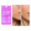 Paq 36 Spot Patches Parche Acne Mariposa Dia Y Noche