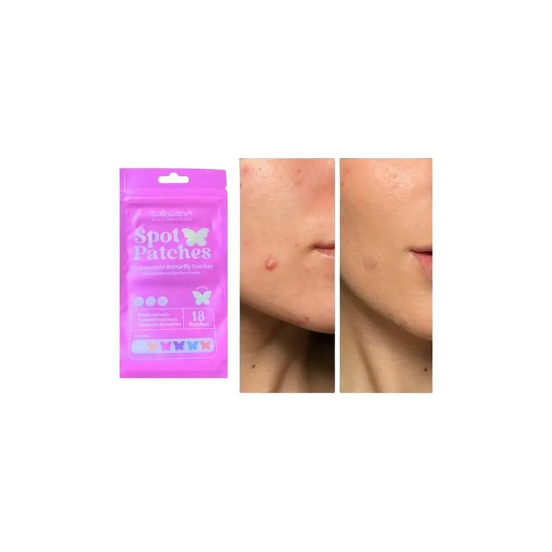 Paq 36 Spot Patches Parche Acne Mariposa Dia Y Noche