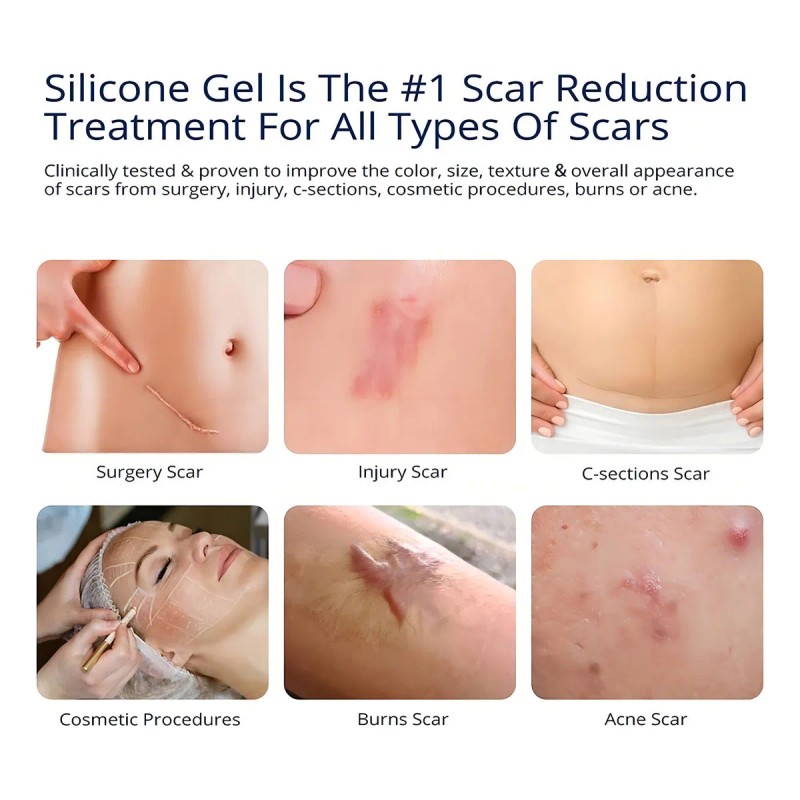 Gel Cicatrizante De Silicona Para Cicatrices Viejas Y Nuevas