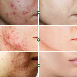 Crema De Tratamiento De Acné Con Ginseng Para Eliminar Las E