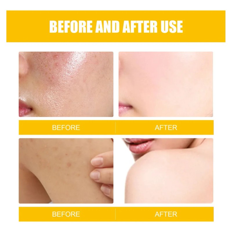 3×crema Para Tratar El Acné: Combate Acné Hormonal Quístico