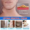 Relieve subcutaneous lumps caused by lipoma-fat cream