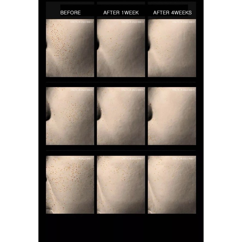 DR.MELAXIN [Dr.Melaxin] BP Bio Spicule Pore Exfoliating Toner Pad 70Pads,K-Beaut