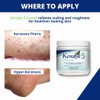 Keralyt 5 Psoriasis Cream - Full Body 5% Salicylic Acid