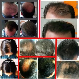 Volosy + Bomba Fibras De Cabello Que Disimulan Calvicie 28g