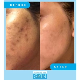 Admire My Skin Dark Spot Corrector Remover for Face - Brightening Discoloration Correcting Serum - Kojic Acid + Azelaic Acid Serum for Melasma Hyperpigmentation And Sun Spots 1oz