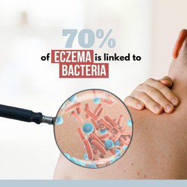 NOVEHA Eczema Relief Spray | Soothing Skin Care for Kids & Adults | Fast Relief | Gentle, Natural Hydration for Dry, Sensitive Skin | 8 OZ