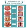 MedEduQuest Heel Pressure Injury Stages Model, Ulcer Demonstration Model