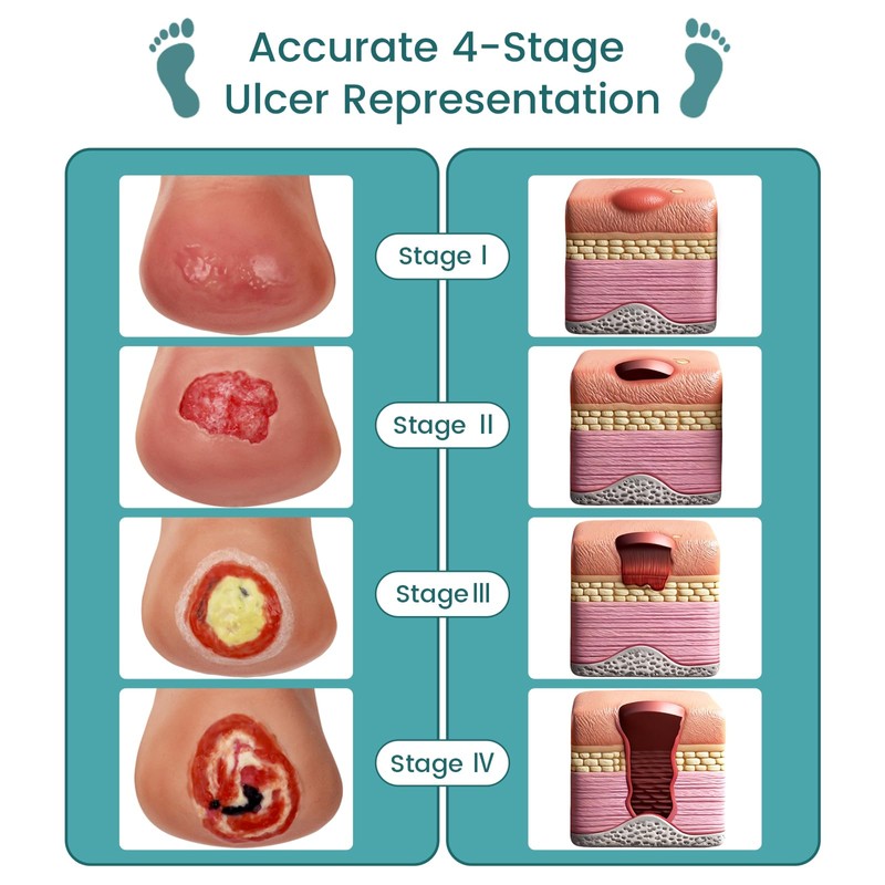 MedEduQuest Heel Pressure Injury Stages Model, Ulcer Demonstration Model