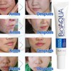 3pcs Crema Pure Skin Elimina Acné y Cicatrices Control De