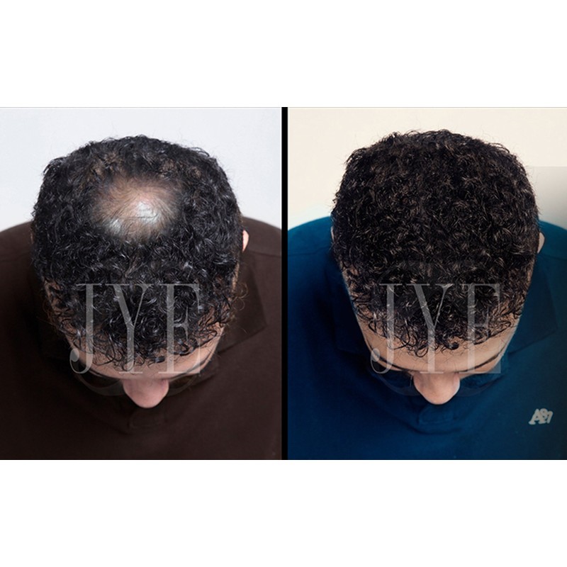 Locion Auxiliar en el tratamiento de crecimiento de cabello Set