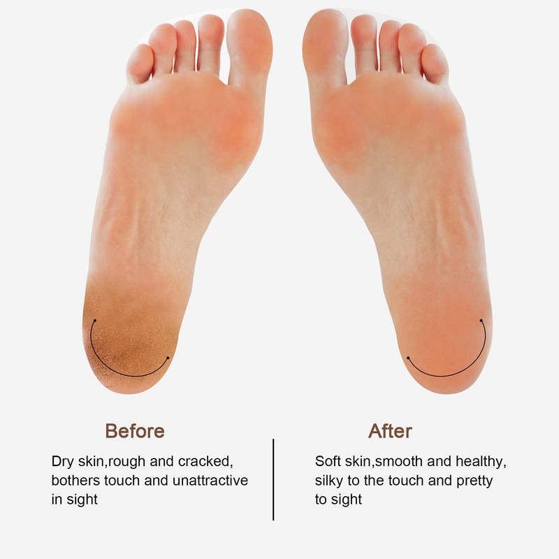 Electric Foot Grinder with LED Light Callus Remover Dead Skin