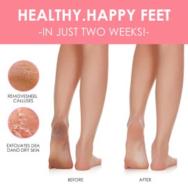 2 Pairs Foot Mask, Callus Socks, Dead and Effectively Removes Moisturising Foot Mask, Foot Care for Delicate Feet, Exfoliating Foot Mask for Men and Women (Strawberry Peach)