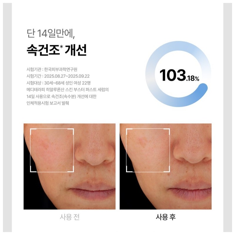 Meditherapy [Peeled Egg Full Package] Hyaluronic Acid Serum 150ml +