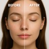Microdermabrasion Keratosis Pilaris & Acne Exfoliating Deep Cleansing Face &