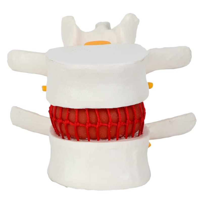 Axis Scientific Human Lumbar Herniating Disc Demonstration Anatomy Model for