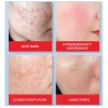 ' For Crema Minimizadora Con Ácido Salicílico, Limpieza De