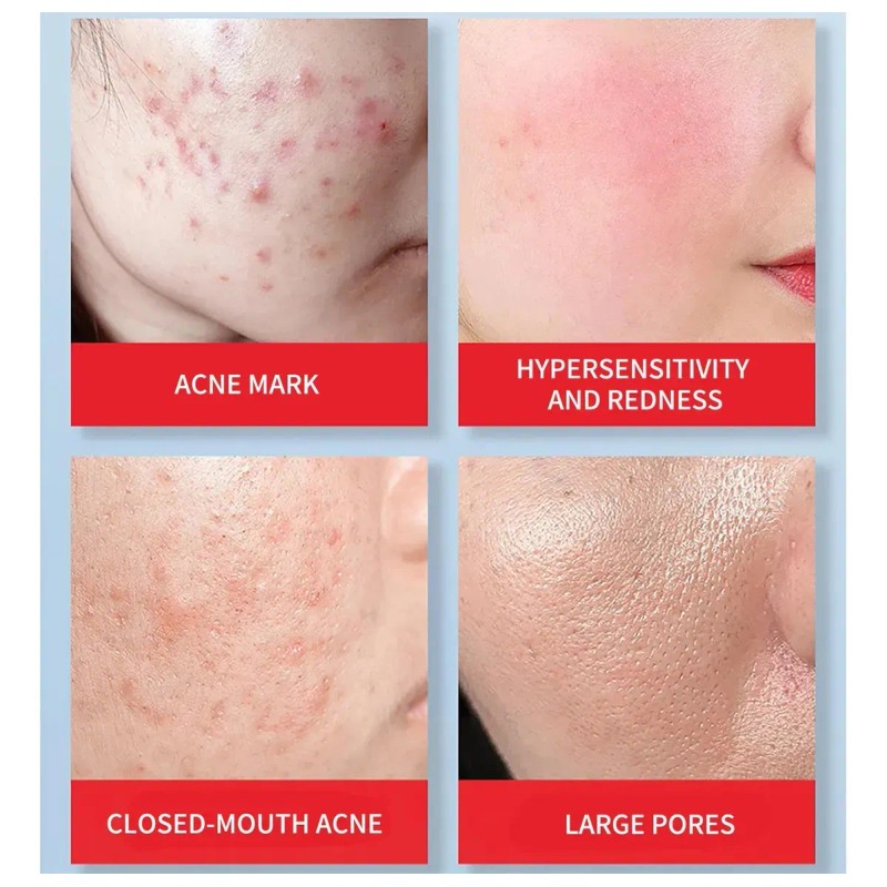 ' For Crema Minimizadora Con Ácido Salicílico, Limpieza De
