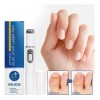 Pluma Luz Azul Elimina Hongo Cuidado Uñas Reparacion Láser F