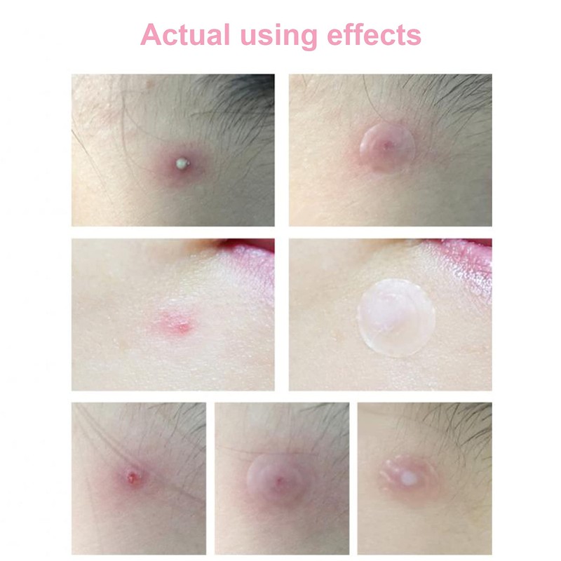 Rpanle Acne Patches, Invisible Hydrocolloid Absorbing Pimple Patches (180 Patches/5