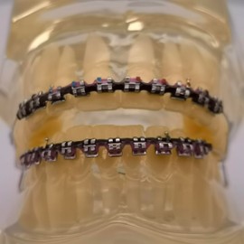 Funny and Fashion Fake Braces Kit With Two Color Teeth Braces Power Chain - Easy Stall For Orthodontist Dental Student Practice (No61-Black&Purple)