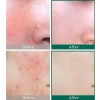 Some by Mi Crema 30 Days Miracle Hidratante Antiacné Ácido