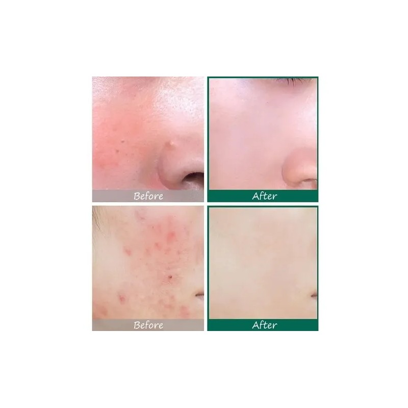 Some by Mi Crema 30 Days Miracle Hidratante Antiacné Ácido