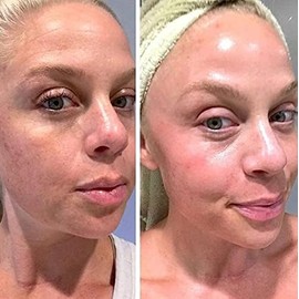 Retinol Gel 0.1 Vitamin A Repairs Fine Lines  Wrinkles, Scar Treatment, Age and Sun Spots, Anti-Aging Formula , 20 Grams