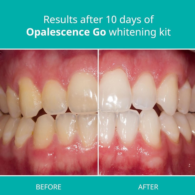 Opalescence Go - Prefilled Teeth Whitening Trays - Original 15%