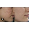 Tratamiento 100% Natural Arrugas Manchas Acne Ojeras Negras