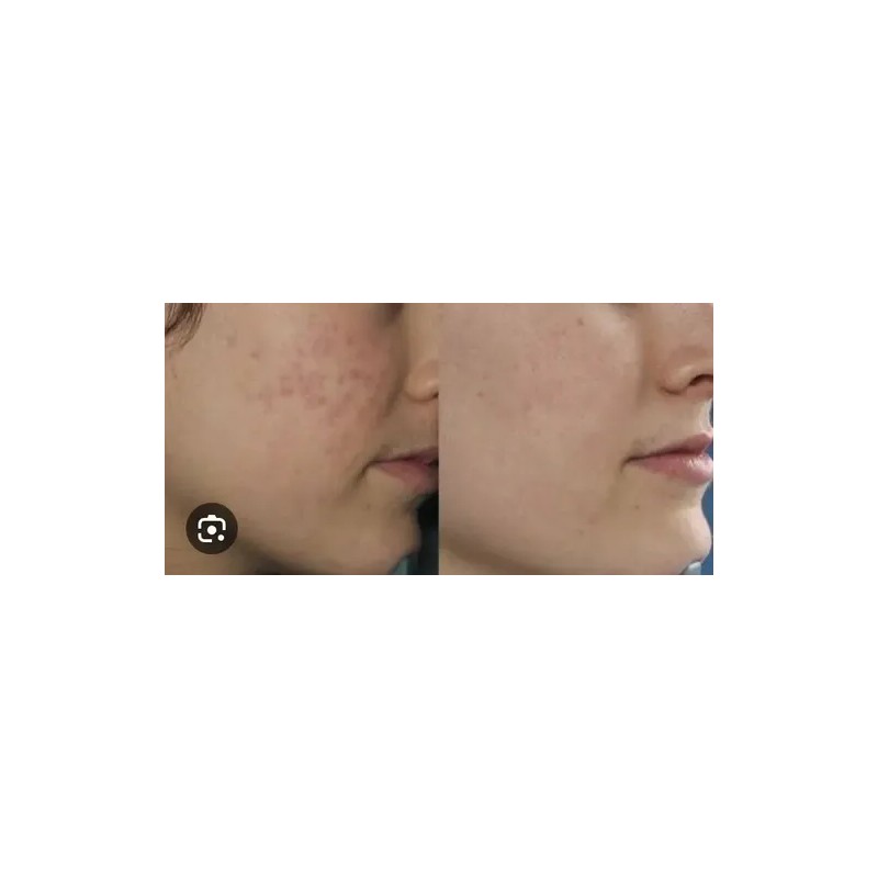 Tratamiento 100% Natural Arrugas Manchas Acne Ojeras Negras