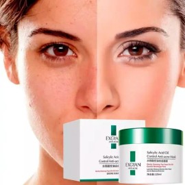 Crema Anti-acné Cuidado Facial Exfoliante Hidratante Skin F                                                                                           