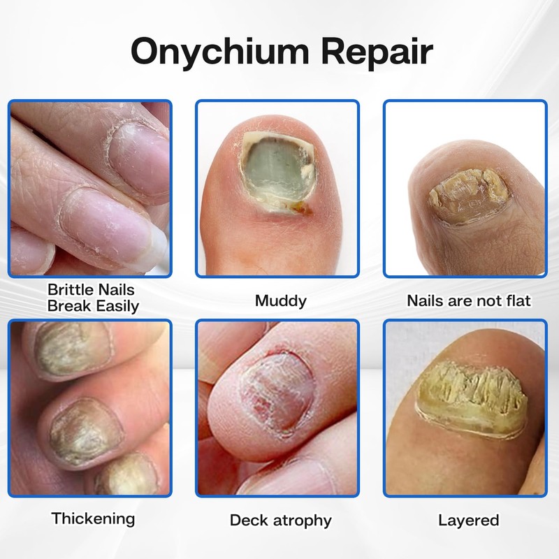 Nail Patches - Toenail Care for Toenail Fingernails - 8-Hour