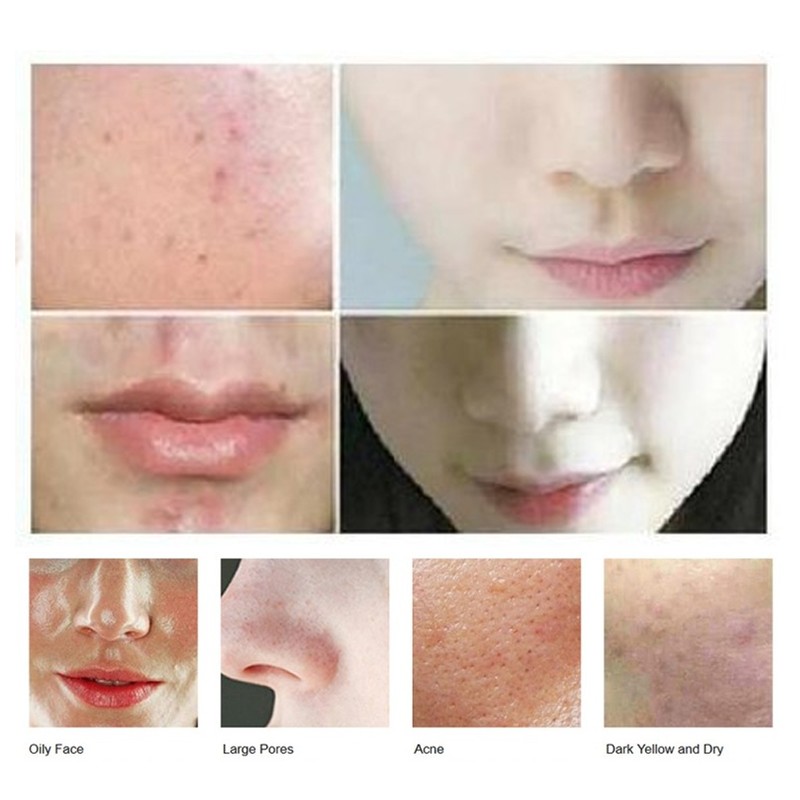 Ultrasonic Skin Scrubber Blackhead Pimple Removal Face Pore Vibration Cleanser
