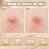 432pzs Parches Estrella Star Anti Acne Espinillas Granos