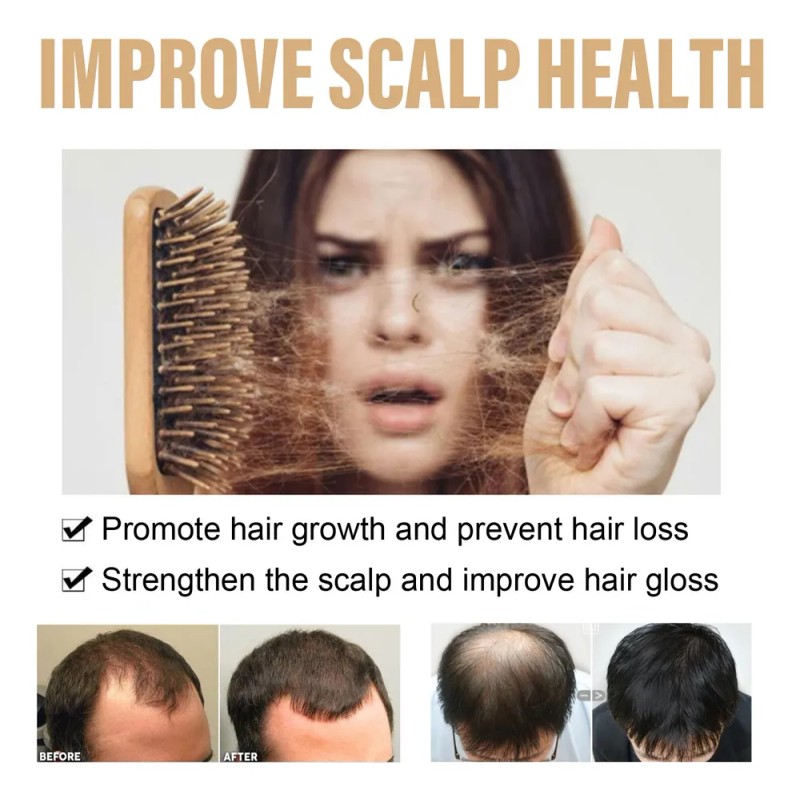 Champú De Cebolla Para El Crecimiento Del Cabello 200ml*2