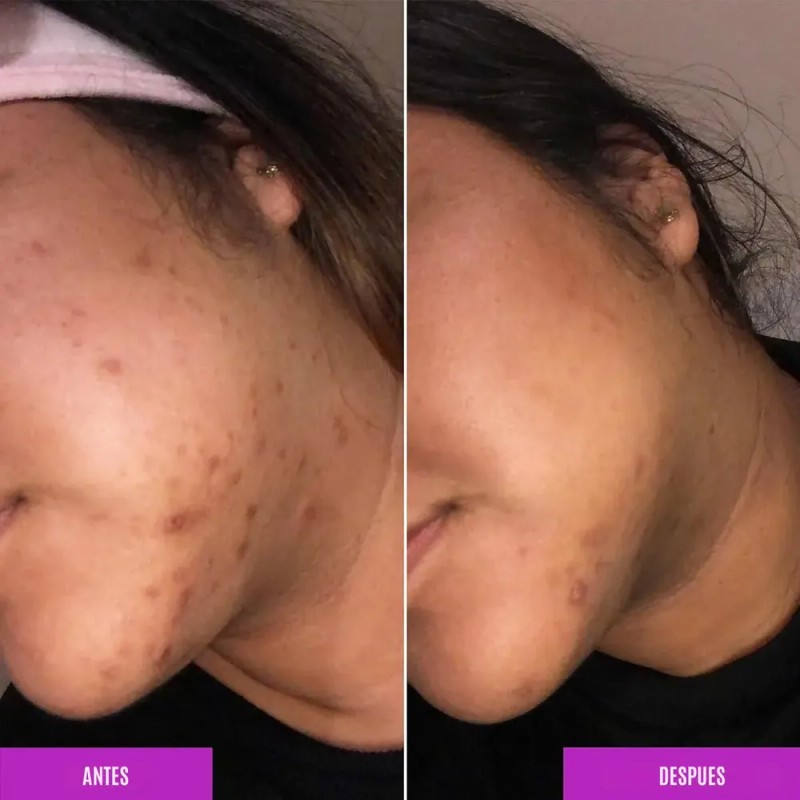 Sérum Despigmentante Good Molecules con Niacinamida y Ácido Tranexámico para