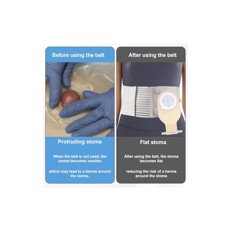 Wider Version Stoma Belt, Adjustable Ostomy Belt, Compatible with Several