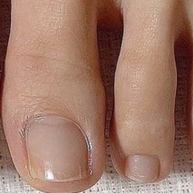 손톱끝갈라짐 조갑박리증 큐티클오일대용량 손톱거스러미영양제 Nail Splitting, Nail Bed Separation Cuticle