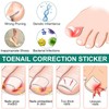 Pack of 50 Toenail Correction Patches for Ingrown Toenails -