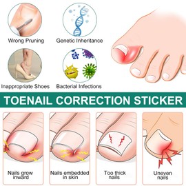 Pack of 50 Toenail Correction Patches for Ingrown Toenails - Plant-Based Formula Toenail Support, Breathable, Easy to Use & Relieve Discomfort