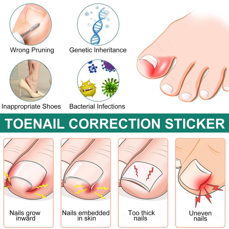 Pack of 50 Toenail Correction Patches for Ingrown Toenails -
