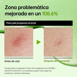 ANUA Sérum Ácido Azelaico 10 Calmante Para Rostro Con Aloe Vera Y Niacinamida 30 mL                                                                   