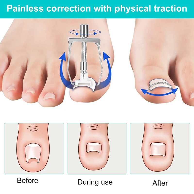 Ingrown Toenails Set Toenail Correction Patch Corrector Pedicure Stainless Steel