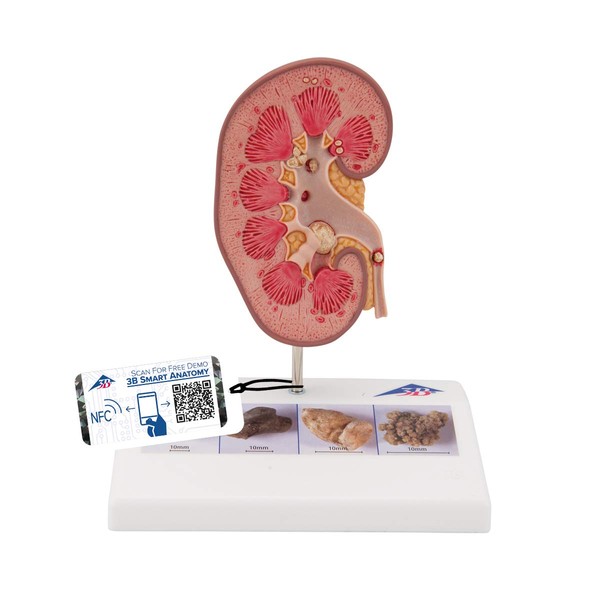 Life-size model reproduces kidney stones and urinary stones, kidney stone model - 3B Scientific