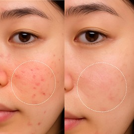 Liv La Fay AHA Face Pads Glycolic + Lactic Acid 100 Cleansing Pads for Face with Niacinamide & Panthenol | Exfoliator for Acne Prone Skin | Refines Pores & Smooths Skin | Zero Pore Pads| Blackheads