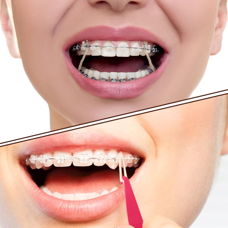 VEGCOO 1000 Pcs Orthodontic Elastic Rubber Bands, 3/16", Braces Teeth